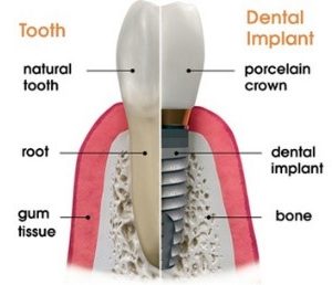 Dental Implants - Empower Dental