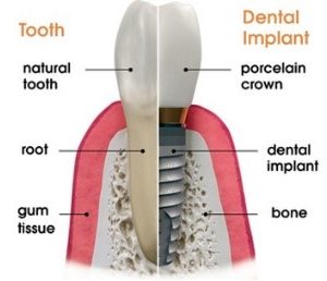 Dental Implants