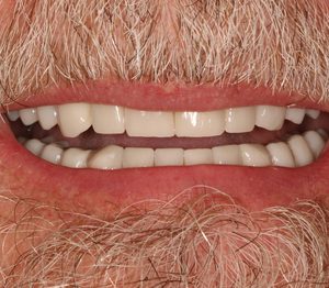Dentures And Partials