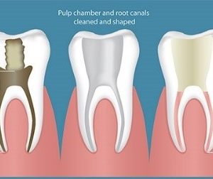 Root Canal Therapy