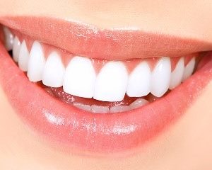 Teeth Whitening