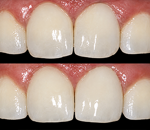 Tooth-Colored Restorations