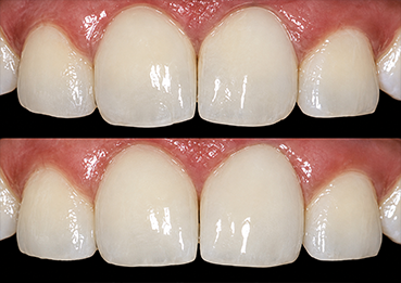Tooth-Colored Restorations